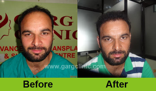 Garg Hair Transplant Clinic