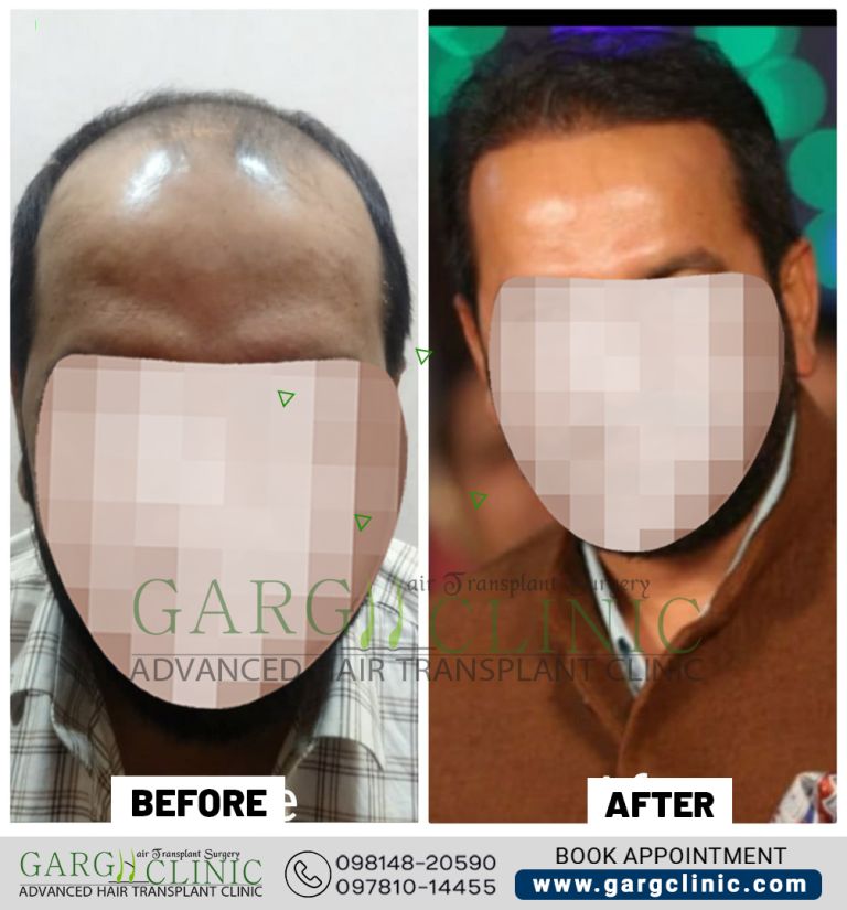 Garg Hair Transplant Clinic