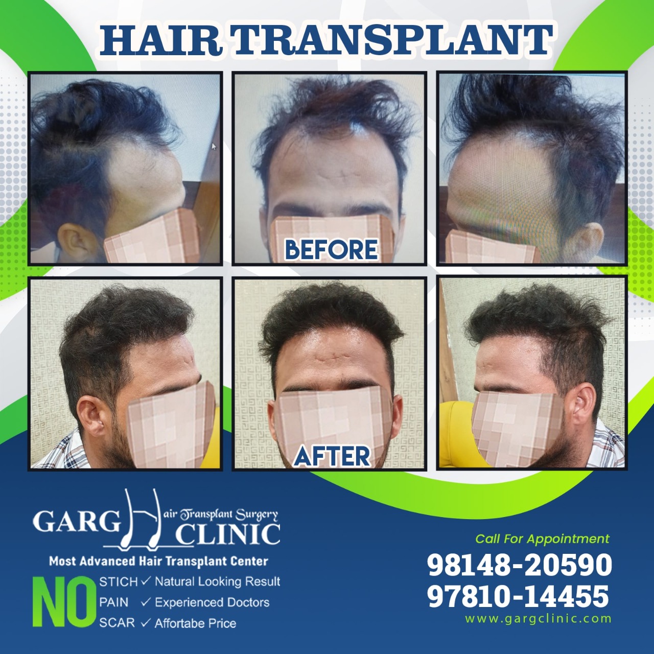 Garg Hair Transplant Clinic