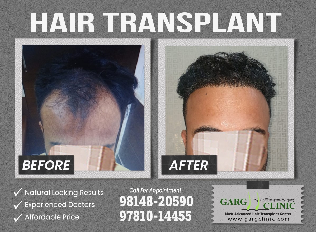 Garg Hair Transplant Clinic