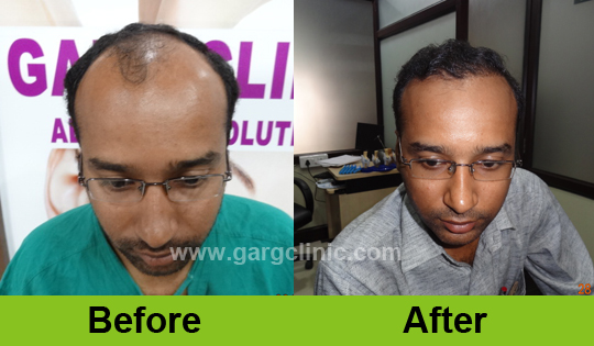 Garg Hair Transplant Clinic