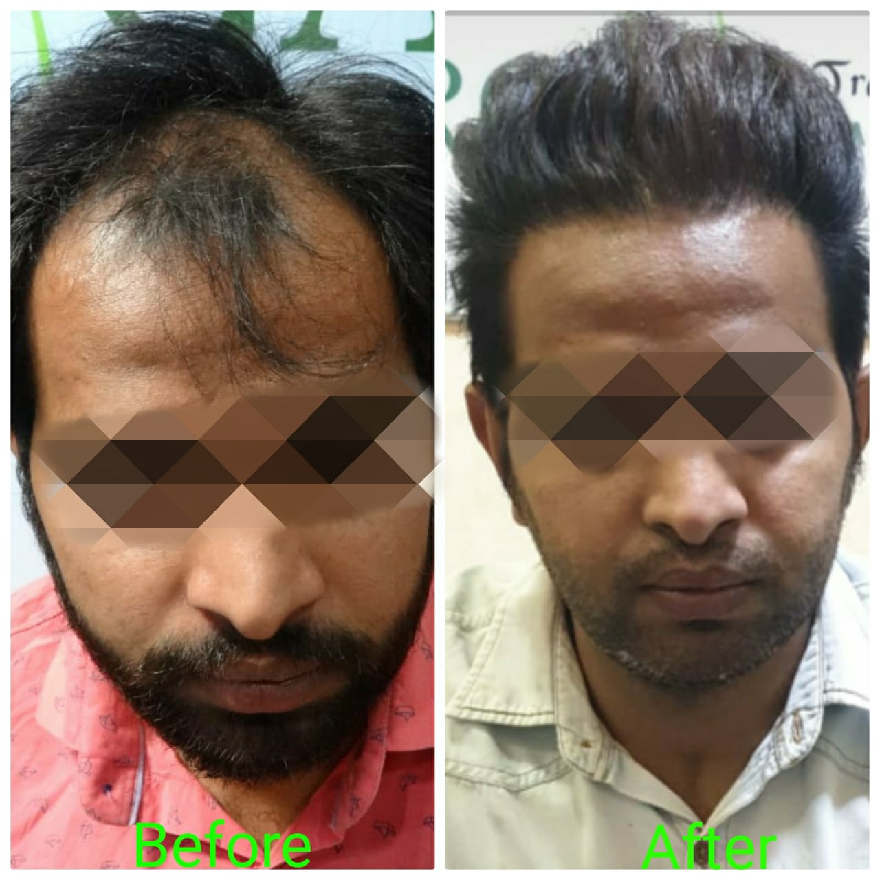 Garg Hair Transplant Clinic