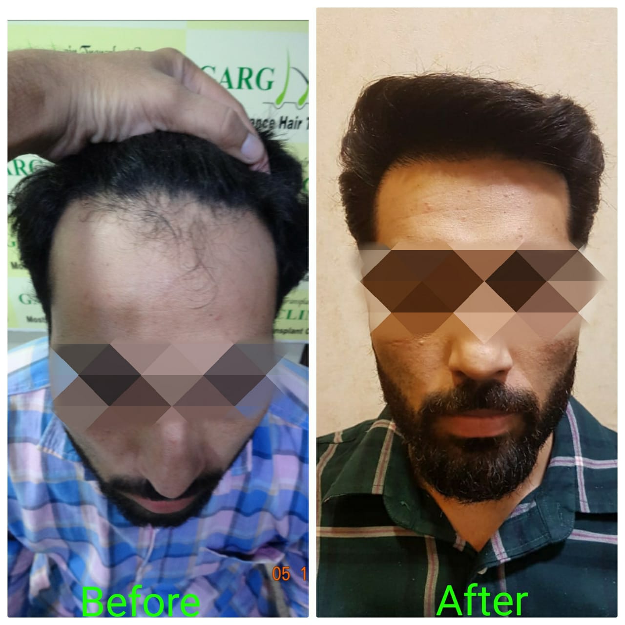 Garg Hair Transplant Clinic