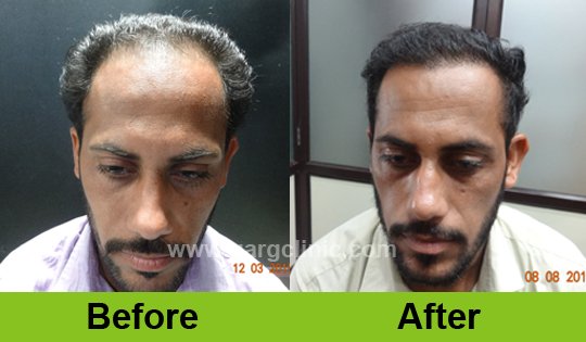 Garg Hair Transplant Clinic