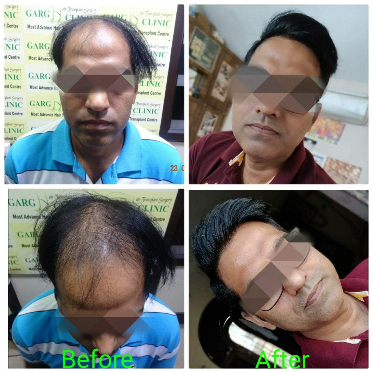 Garg Hair Transplant Clinic