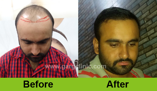 Garg Hair Transplant Clinic
