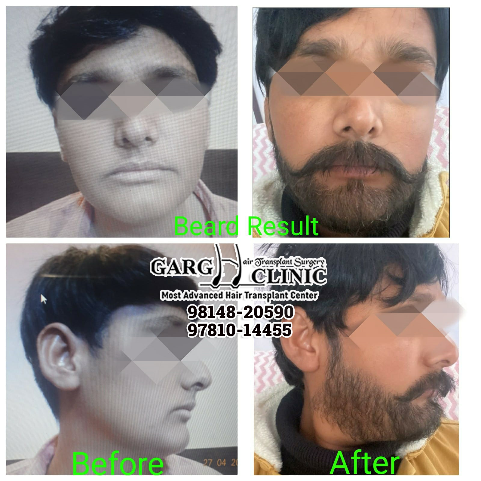 Garg Hair Transplant Clinic