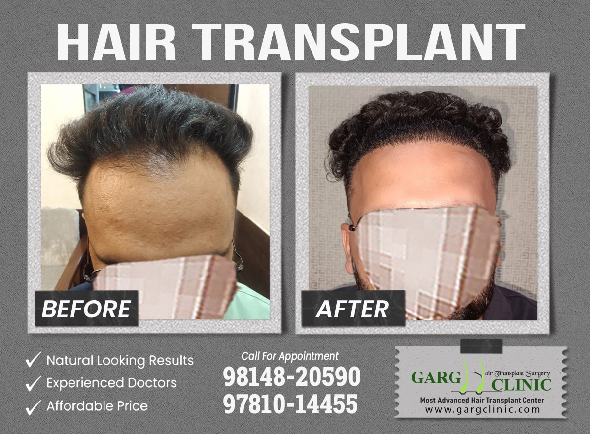 Garg Hair Transplant Clinic