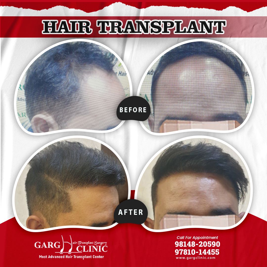 Garg Hair Transplant Clinic