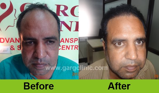 Garg Hair Transplant Clinic