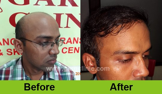 Garg Hair Transplant Clinic