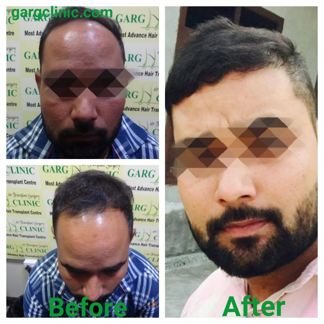 Garg Hair Transplant Clinic