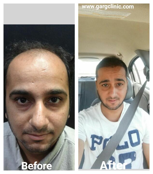 Garg Hair Transplant Clinic