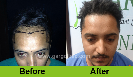 Garg Hair Transplant Clinic