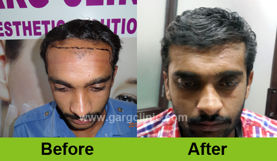 Garg Hair Transplant Clinic