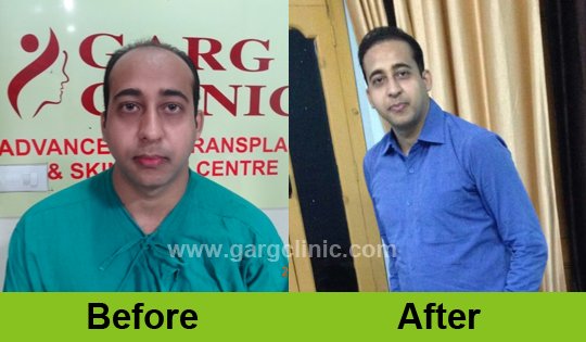 Garg Hair Transplant Clinic