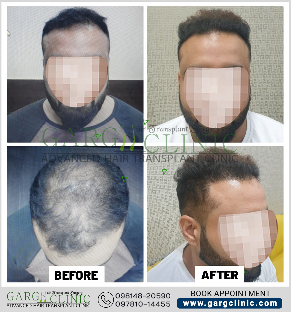 Garg Hair Transplant Clinic