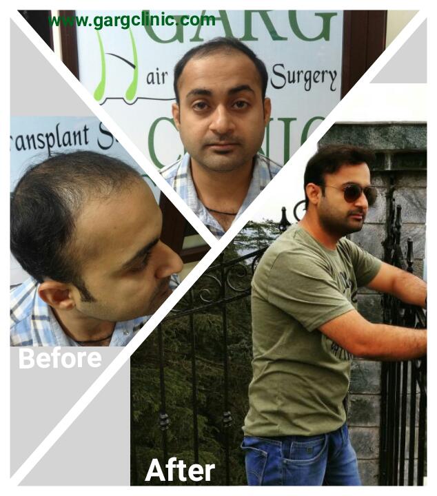 Garg Hair Transplant Clinic