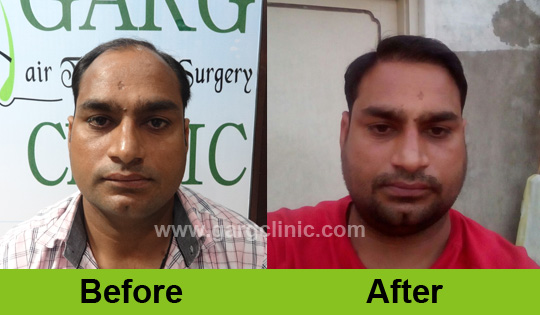 Garg Hair Transplant Clinic