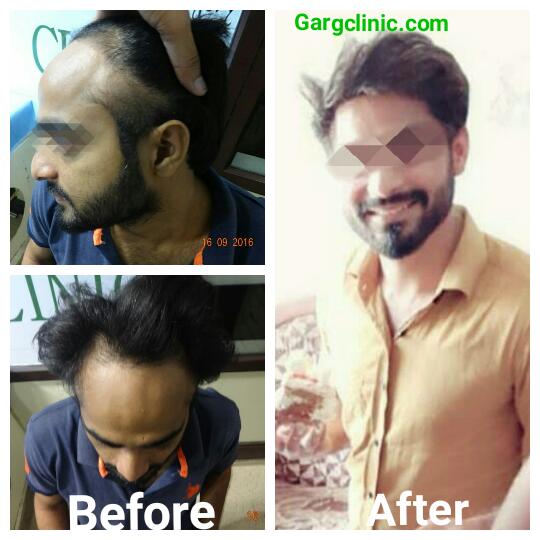 Garg Hair Transplant Clinic