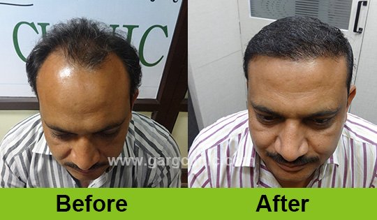 Garg Hair Transplant Clinic