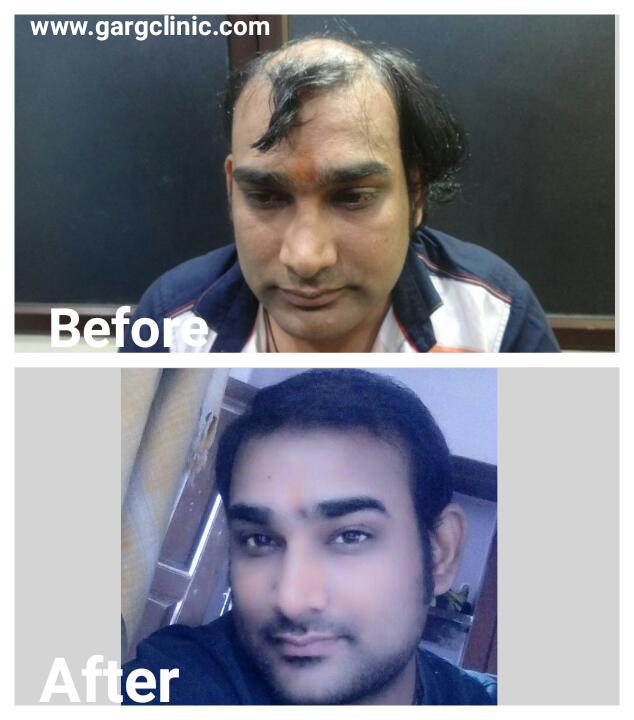 Garg Hair Transplant Clinic