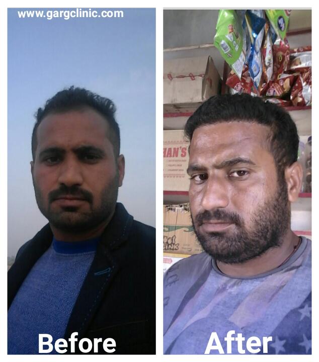 Garg Hair Transplant Clinic