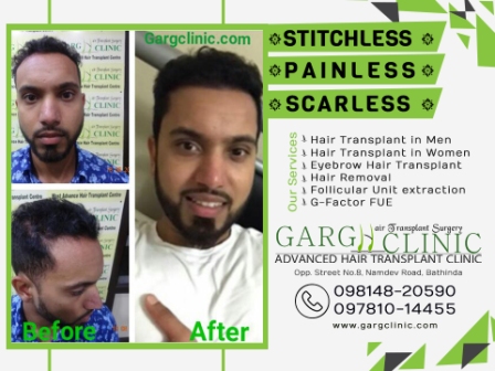 Garg Hair Transplant Clinic