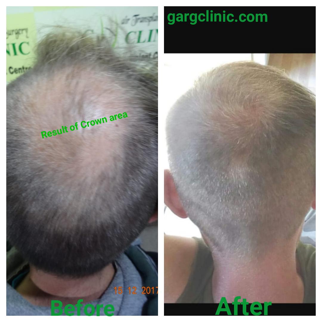 Garg Hair Transplant Clinic