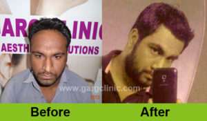 Garg Hair Transplant Clinic