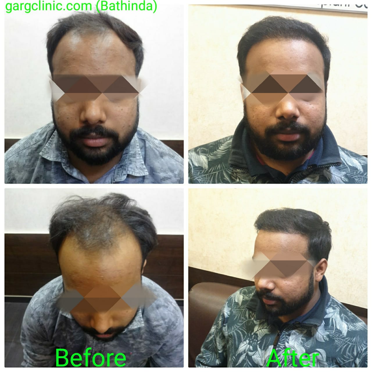 Garg Hair Transplant Clinic