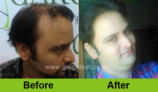 Garg Hair Transplant Clinic