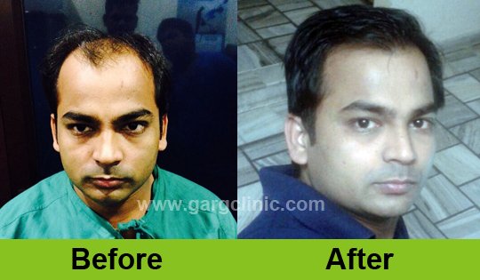 Garg Hair Transplant Clinic