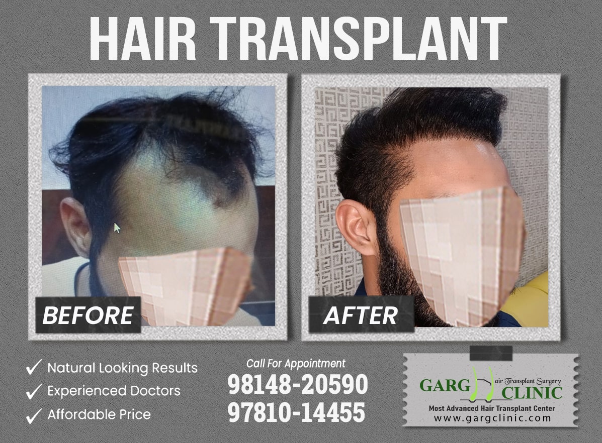 Garg Hair Transplant Clinic