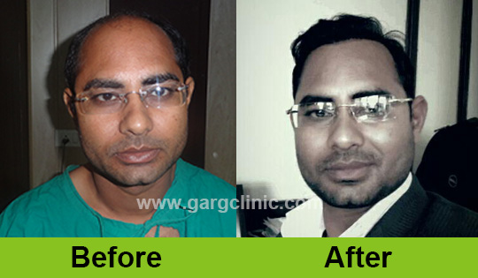 Garg Hair Transplant Clinic