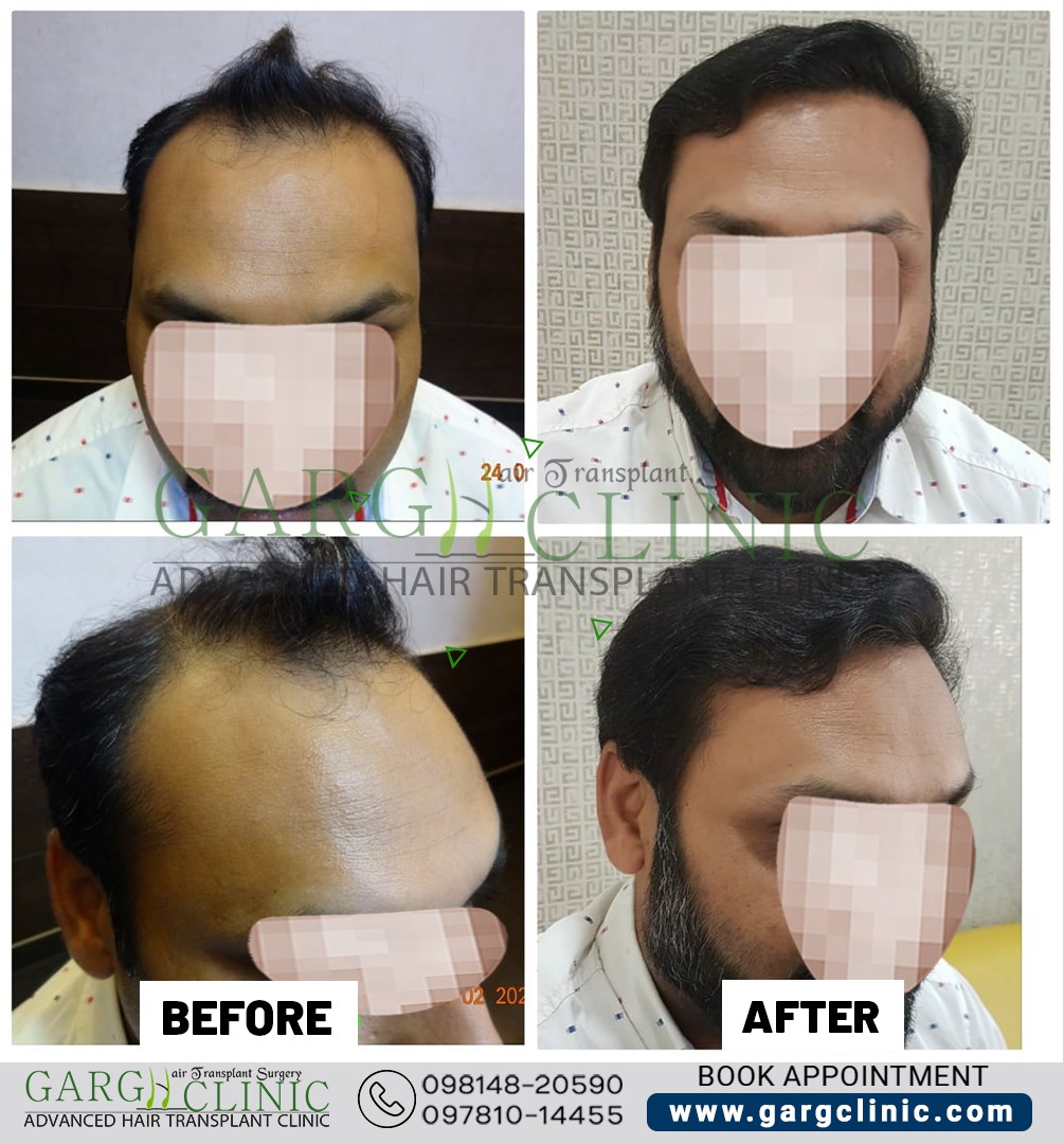 Garg Hair Transplant Clinic