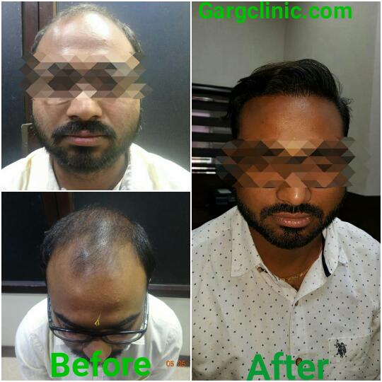 Garg Hair Transplant Clinic