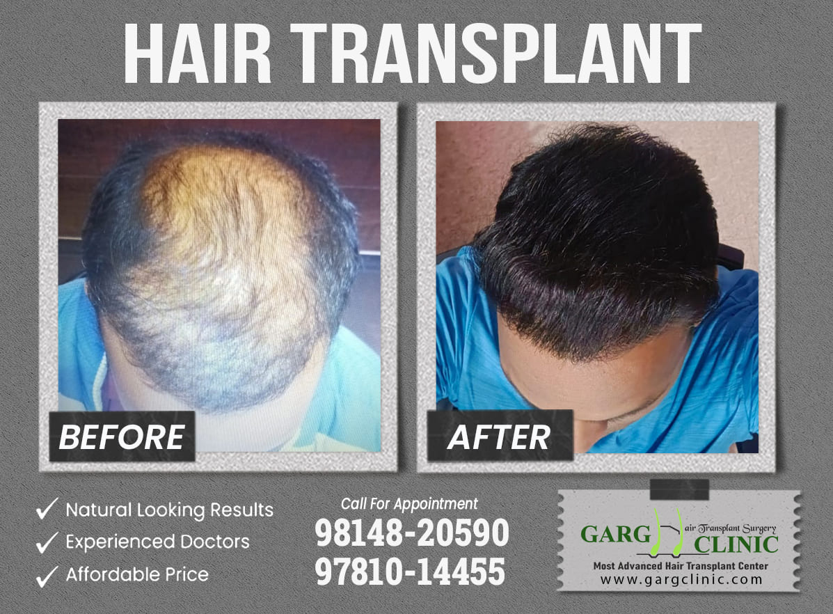 Garg Hair Transplant Clinic