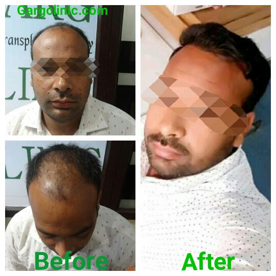 Garg Hair Transplant Clinic