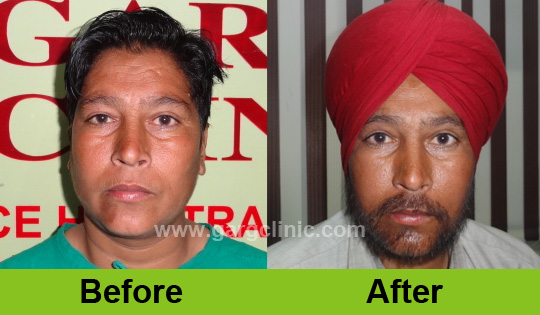 Garg Hair Transplant Clinic