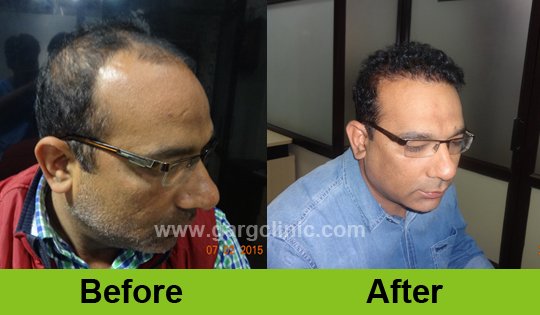 Garg Hair Transplant Clinic