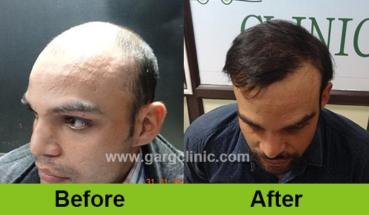Garg Hair Transplant Clinic