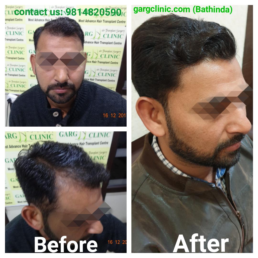 Garg Hair Transplant Clinic