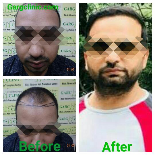 Garg Hair Transplant Clinic