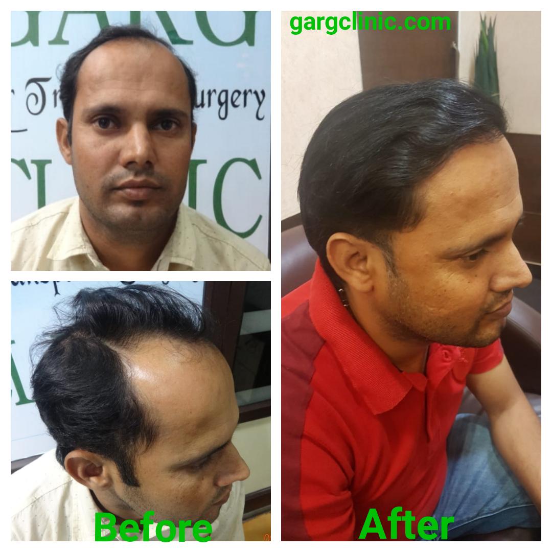Garg Hair Transplant Clinic