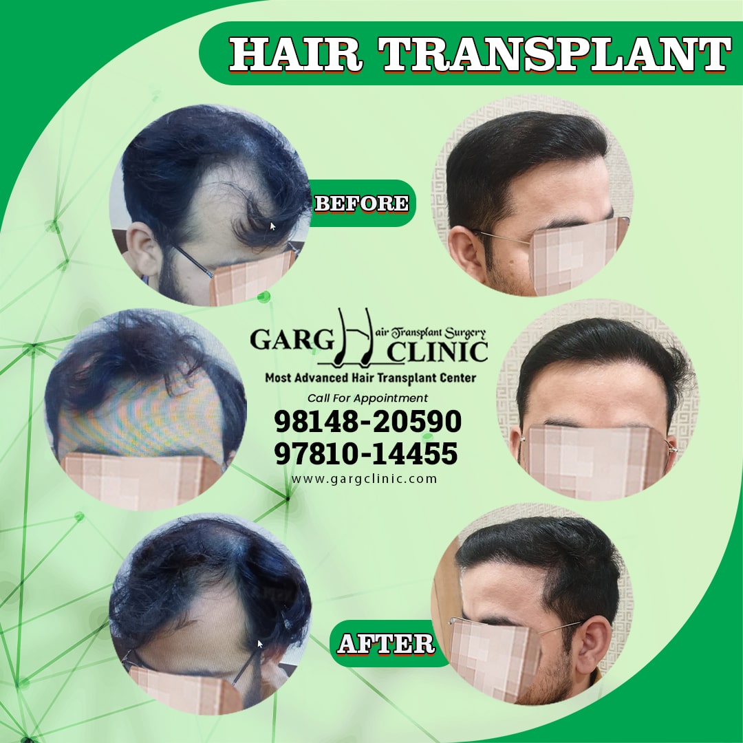Garg Hair Transplant Clinic