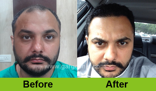 Garg Hair Transplant Clinic