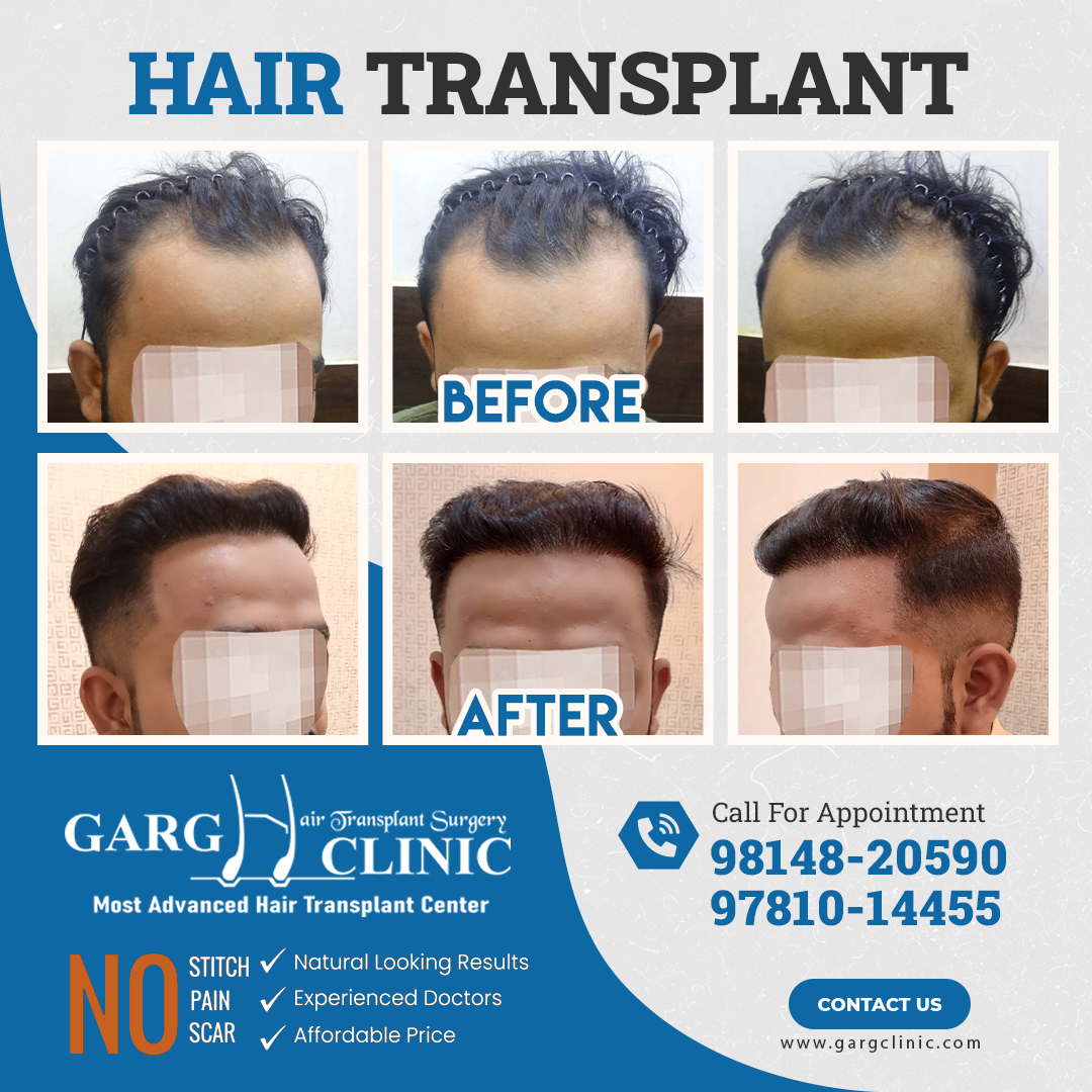 Garg Hair Transplant Clinic
