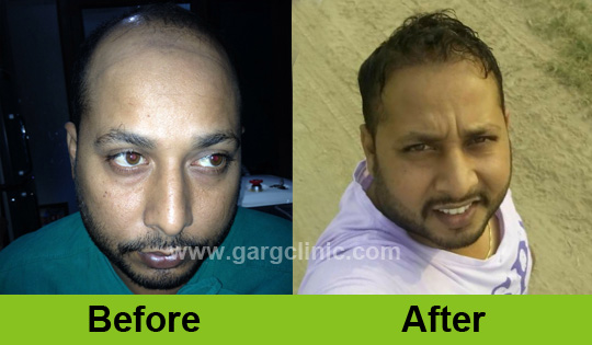 Garg Hair Transplant Clinic