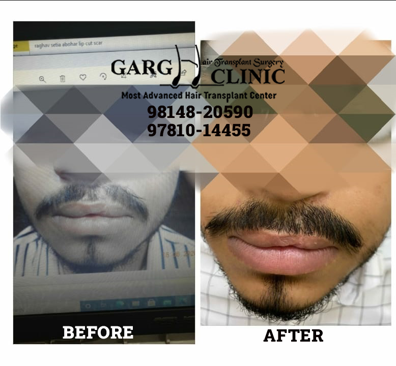 Garg Hair Transplant Clinic